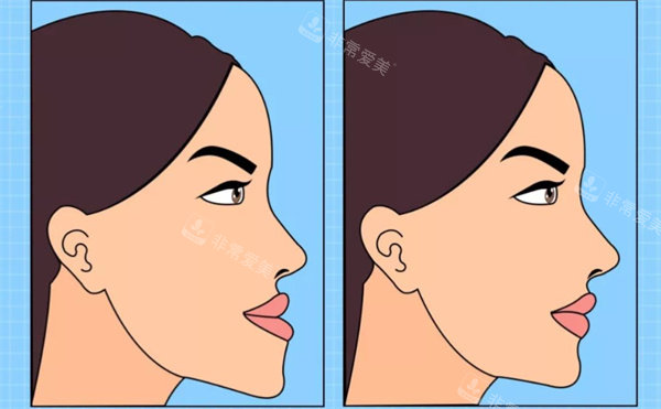 牙齿矫正卡通对比图
