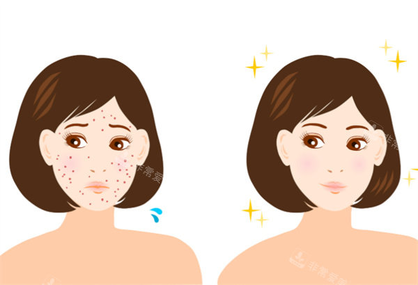 祛痘前后对比卡通图