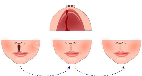 韩国做唇裂修复手术哪家医院好，这几家医院技术实力强服务贴心口碑好！