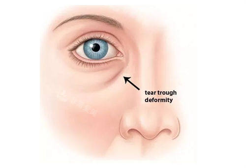 泪沟标注动画示意图