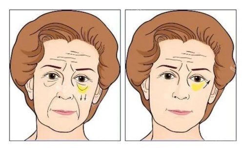 胶原蛋白去泪沟术后对比示意图 胶原蛋白去泪沟术后对比示意图