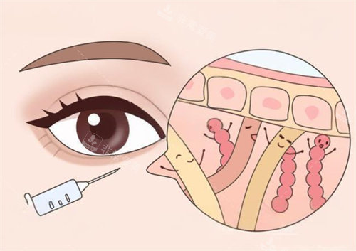 眼周抗衰注射卡通图 眼周抗衰注射卡通图