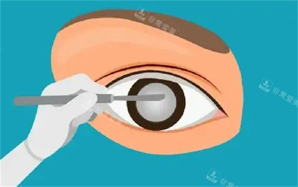 白内障手术治疗卡通图