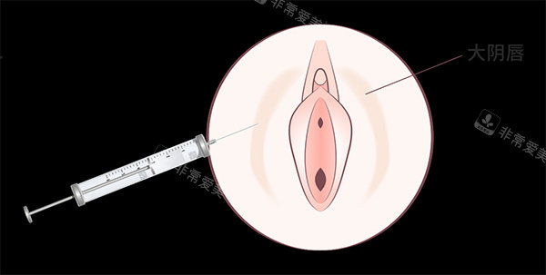 私密阴唇注射照片