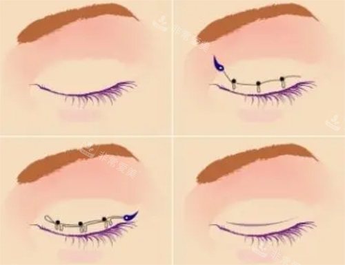 成都双眼皮哪个医生好？林靖、卢尚兵、蔡灵、高亮等医生汇总！