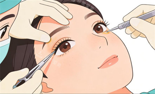 雙眼皮修復(fù)卡通動(dòng)畫(huà)圖