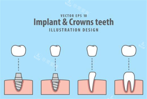 牙齿种植过程图示意图