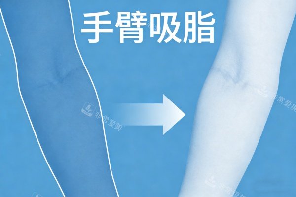 手臂做吸脂卡通图一览