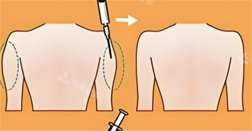 手臂吸脂前后对比