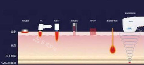 超声炮改善展示图照片