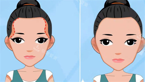 太阳穴凹陷前后对比图