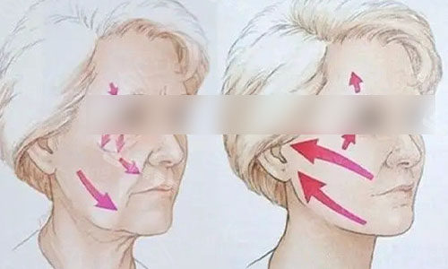 做拉皮手术前后动画图