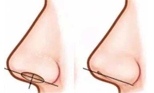 鼻頭縮小對比 鼻頭縮小對比