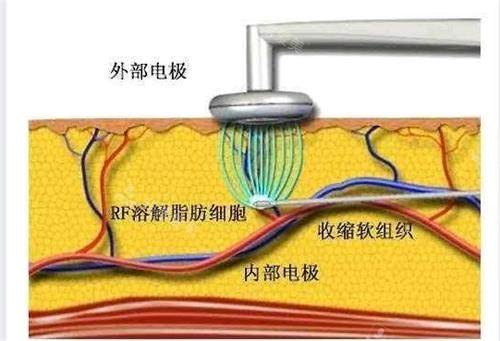 想美白又怕反黑？我花70万韩币做的5次黄金焕肤真实感受！