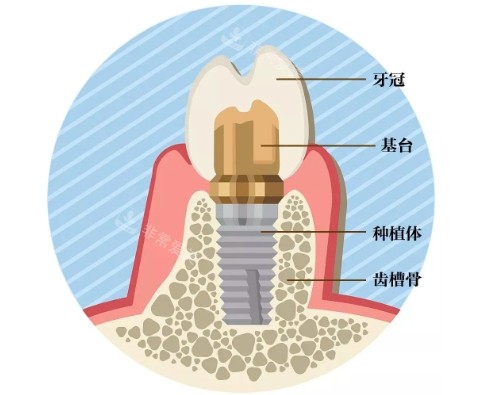 种植牙组成展示图