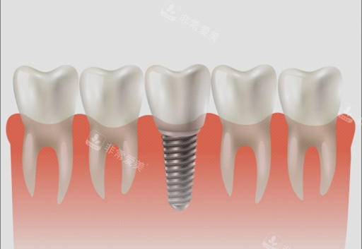 种植牙单颗漫画示意图