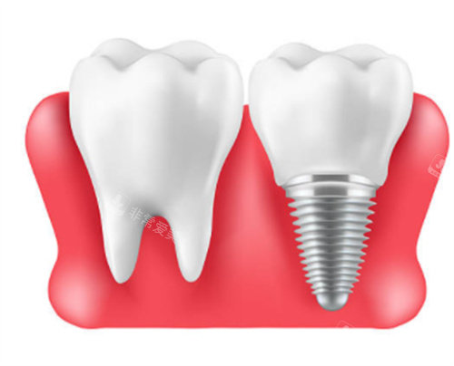 自然牙和种植牙