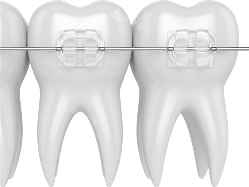 牙齿矫正陶瓷托槽漫画图