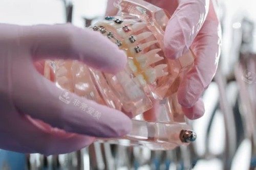 牙齿模型参考图