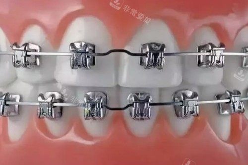 金属矫正卡通模型图