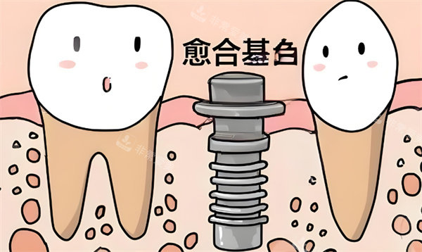 种植牙卡通动画图片展示