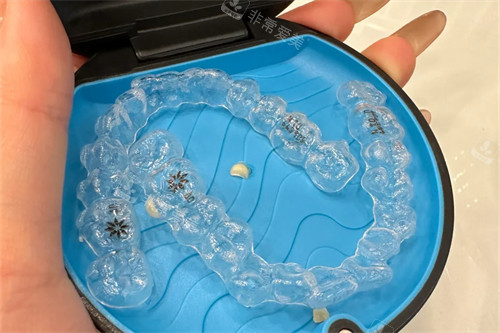 美国隐适美隐形矫正牙套