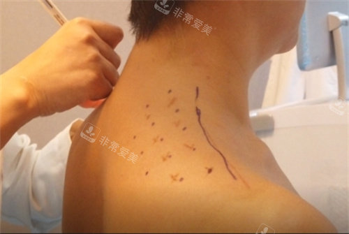 直角肩注射位置术前设计