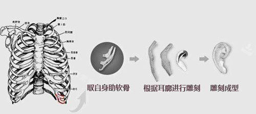 肋軟骨耳再造支架.webp