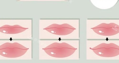 韩国丰唇哪家皮肤科审...