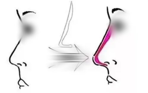 隆鼻手術(shù)填充前后對(duì)比圖