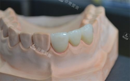 安装在牙齿模型上的全瓷牙成效