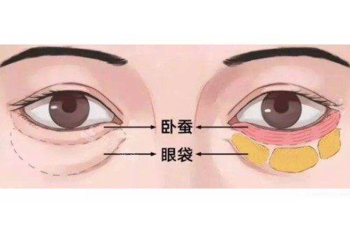 眼袋、卧蚕区分图