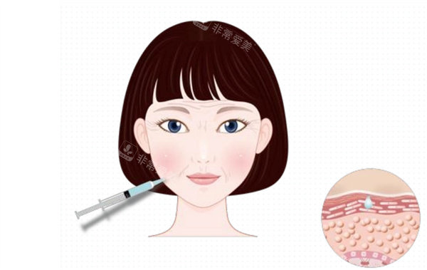 面部注射除皱卡通图