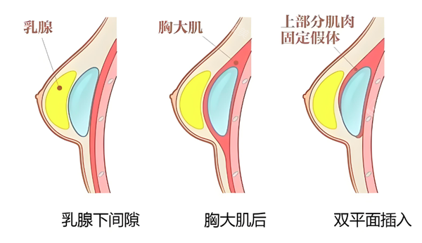 假体隆胸植入层次