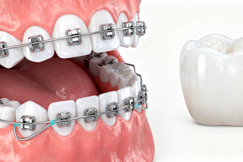 牙齿矫正卡通展示图