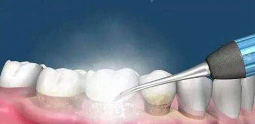 洗牙卡通示意图