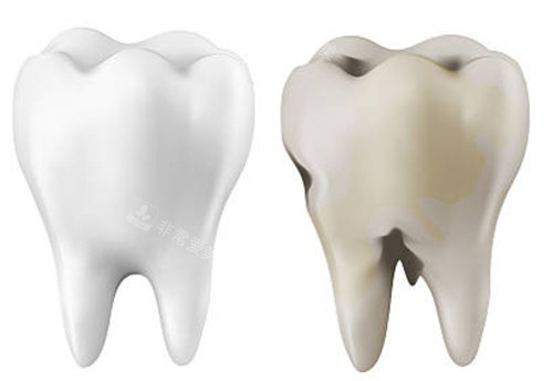 正常牙齿和坏的牙齿