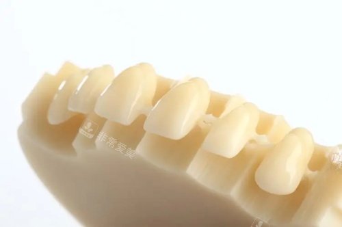 国产美晶瓷全瓷牙展示图