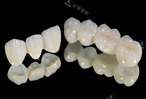 国产爱尔创全瓷牙