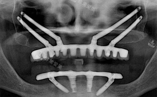穿颧穿翼种植拍片