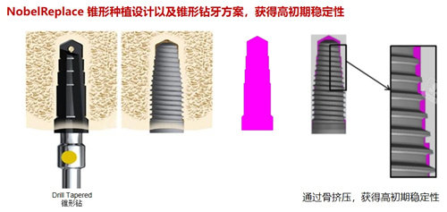 诺贝尔种植牙 (2)