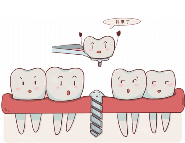 种植牙治疗卡通图