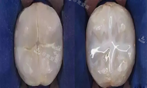 牙齿窝沟封闭卡通示意图