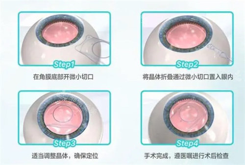 晶体植入的过程