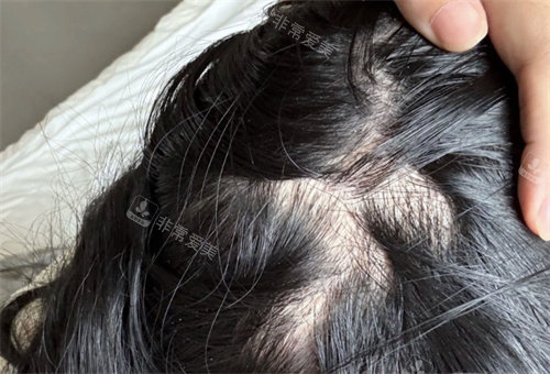 广州市菲思医疗美容毛发种植图