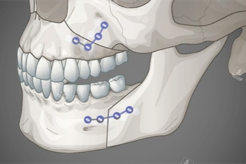 雙鄂手術(shù)概念圖