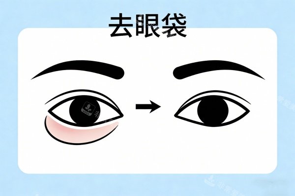 祛除眼袋前后对比图