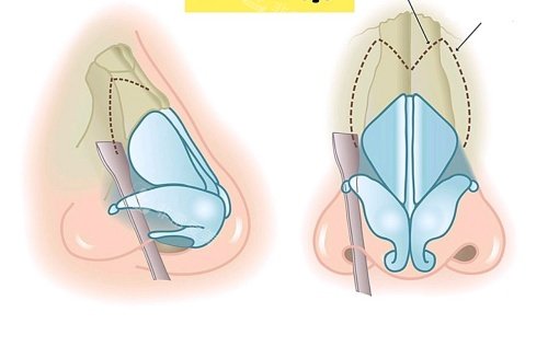 鼻骨内推部位示意图
