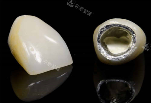 一颗烤瓷牙素材