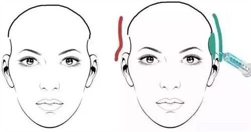 太陽穴凹陷玻尿酸注射對比動畫圖 太陽穴凹陷玻尿酸注射對比動畫圖